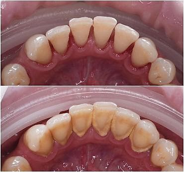 Профессиональная чистка зубов от зубного камня и налёта(женский прием)