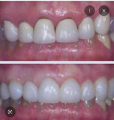 сколько стоит поставить брекеты на зубы: Врачи | Стоматолог | Протезирование, Другие медицинские услуги — 1