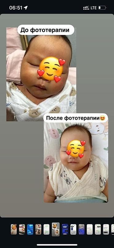 НОВЫЕ ЛАМПЫ. Эффект через сутки🔥 Фотолампа для лечения неонатальной