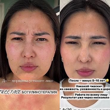 Косметология, Ботулинотерапия, Сертифицированный косметолог