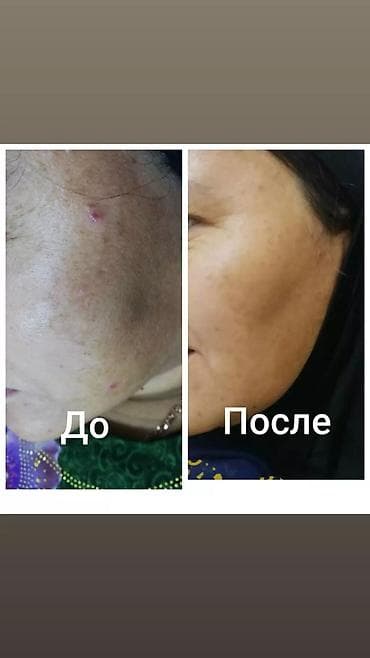 парикмахеры кресло: Лазерная эпиляция. Аппаратная Чистка лица. Карбокситерапия. Лечение — 7