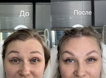 face: Косметологические услуги для лица и тела: 💎Ботокс -разглаживание — 1