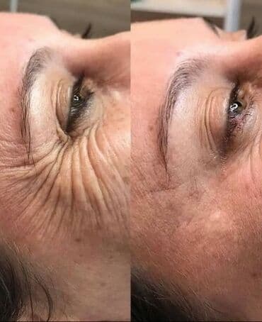 Детские сады, няни: Биоревитализация Препарат Корея🇰🇷 Медицинское образование✅ Сертификат✅ — 2