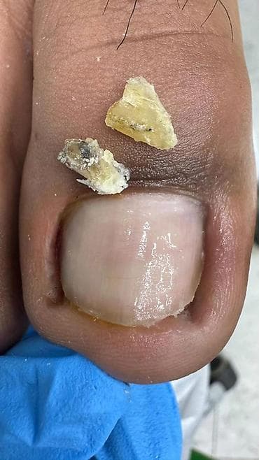 апарат станок: Коррекция вросших ногтей, Педикюр, Одноразовые расходные материалы — 1