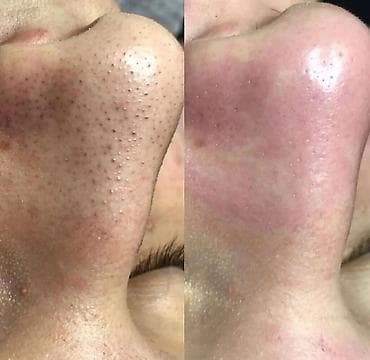 лазерная шлифовка лица бишкек: Уход за кожей лица: профессиональная чистка и пилинги - — 4