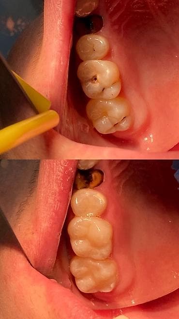 Стоматологическая услуга: лечение кариеса и восстановление жевательных