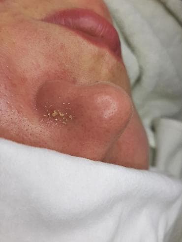 лазерная шлифовка лица цена бишкек: Чистка лица косметолог с мед оброзованием мед центр возле ГУМа с — 3