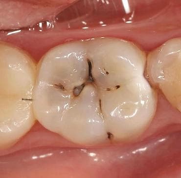 клиника дентомакс бишкек: Лечение кариеса 
Фотопломба
Чистка
Удаление 
Протезирование — 6