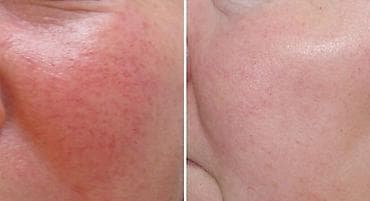 samsung 21: Удаление сосудистых звёздочек и купероза на лице - Аппаратная — 3