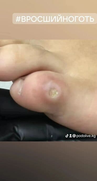 маникюр педикюр с выездом на дом: Коррекция вросших ногтей, Выравнивание, Услуги подолога, Маникюр, Педикюр, С выездом на дом, Консультация, Одноразовые расходные материалы — 1