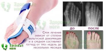 Вальгус шиналары: Бандаж для косточки на ноге купить стоит из-за его поистине lalafo.kg да — 4 Вальгус шиналары: Бандаж для косточки на ноге купить стоит из-за его поистине — 4