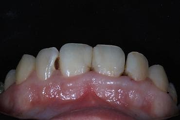 Виниры/коронки для реставрации передних зубов - Комплексная