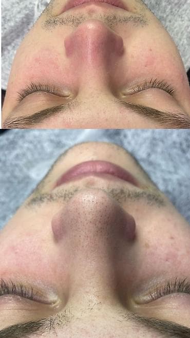 Косметология, Терини тазалоо, Консультация — 2