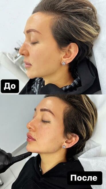 слива ферментированная капсула для похудения отзывы: Косметология, Биоревитализация, Контурное моделирование, Лечение угревой болезни, Сертифицированный косметолог — 4