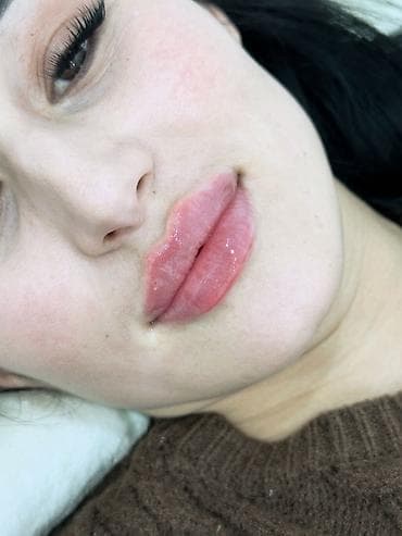 подтяжка лица: Увеличение и моделирование губ филлерами - Эстетическая коррекция — 7