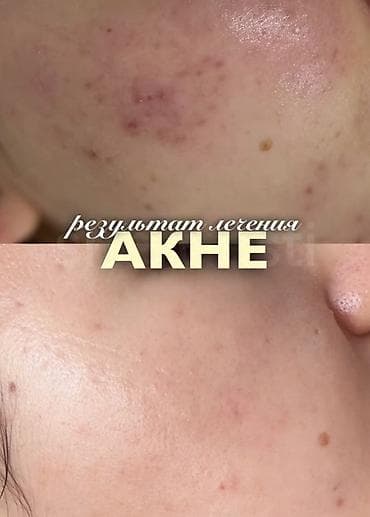 Косметология, Лечение угревой болезни, Маски, Массаж лица, Гипоаллергенные материалы
