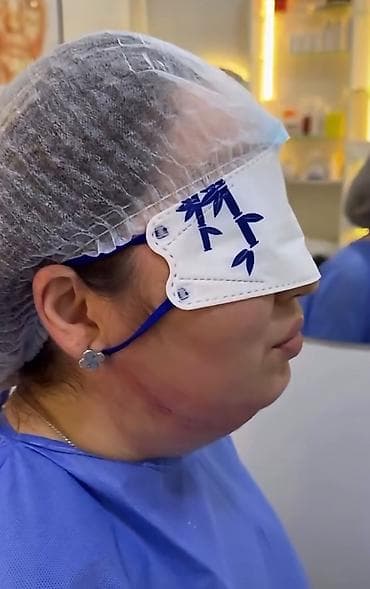 лицо: Липосакция второго подбородка и брыли по Акции вместо 35000с со — 1