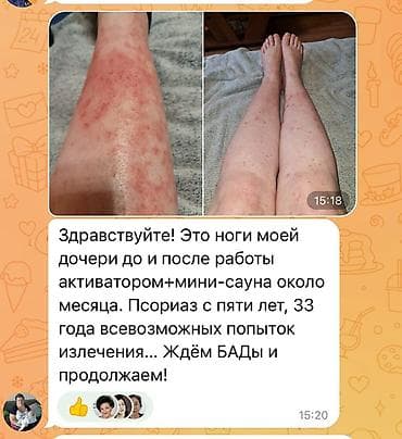 Продается новый Активатор клеток WHIEDA (FOHERB) Для лечение псориаза — 3