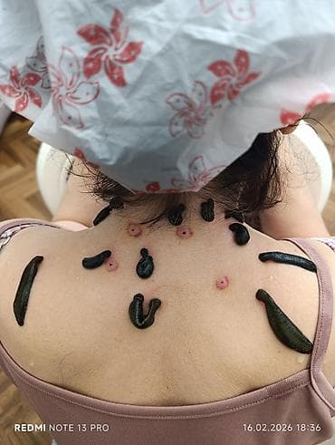 медицинские пиявки: Врачи | Гирудотерапевт | Лечение пиявками — 8