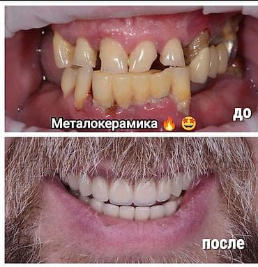 отбеливание зубов: Клиника | Стоматолог | Протезирование — 8