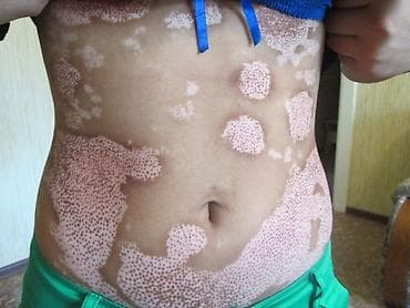 Нитриловые перчатки: Витилиго средство — 5