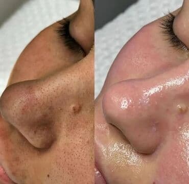 накладные брекеты для красоты купить: Косметология, Пилинг, Чистка кожи, Консультация, Гипоаллергенные материалы, Сертифицированный косметолог — 3