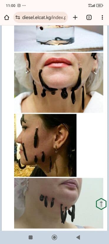 хиджама кровопускание: Врачи | Гирудотерапевт | Лечение пиявками — 11