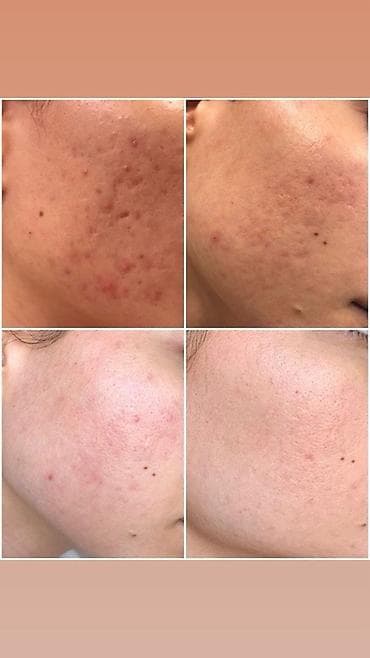 intel xeon: Профессиональные процедуры для кожи лица: лечение акне, постакне и — 3