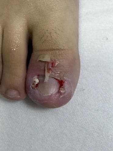 ноктя: Предлагается профессиональная услуга по лечению вросшего ногтя — 3