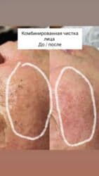 гель для узи: Комбинированная чистка лица: механическая + ультразвуковая — 7