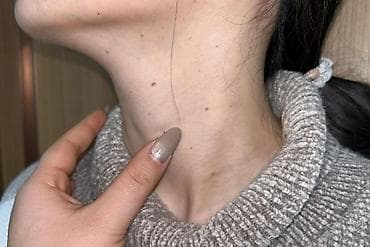 чач уштук: Мазь от бородавок и папиллом
50 мг — 7