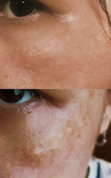 эффективный отбеливающий крем для зоны бикини в аптеке: Expigment Экспигмент Сроки до 2027 Свежая поставка с Турции 🇹🇷 💯% — 18