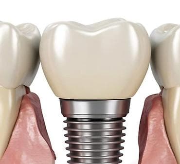 патолок уста: Dentium SuperLine — стоматологические импланты.Производство Южная — 1