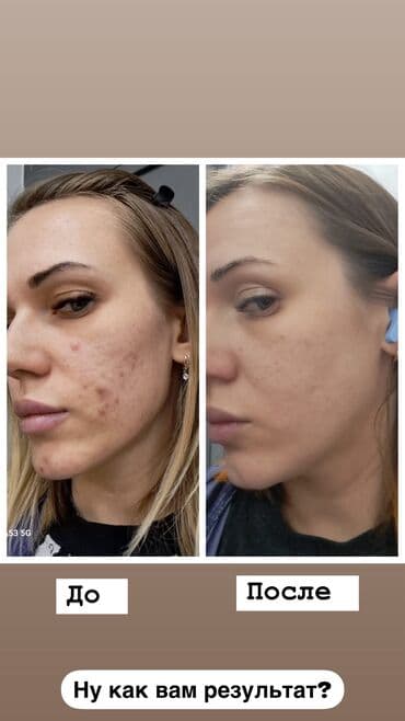 Косметология, Чистка кожи, Консультация, Гипоаллергенные материалы, Сертифицированный косметолог at lalafo.kg Косметология, Чистка кожи, Консультация, Гипоаллергенные материалы, Сертифицированный косметолог