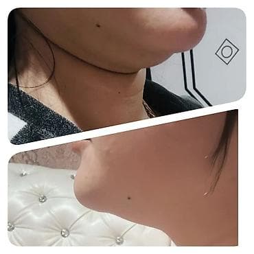 лечебные массаж ош: Лазерная эпиляция. Чистка лица. Лечение акне. Гименопластика — 3