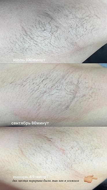 Сулуулук жана ден-соолук: Электроэпиляция — профессиональное удаление волос с любой зоны — 2