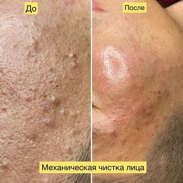 слива ферментированная капсула для похудения отзывы: Косметология, Лечение угревой болезни, Пилинг, Плазмолифтинг, Гипоаллергенные материалы, Консультация, Сертифицированный косметолог — 1