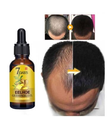 Киреге берилүүчү кийимдер: ❄️ От облысения - имбирь выпадения волос быстрое восстановление — 5