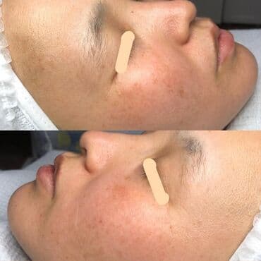 хиджама кровопускание: Косметология, Чистка кожи, Биоревитализация, Пилинг, Сертифицированный косметолог, Гипоаллергенные материалы, Консультация — 4