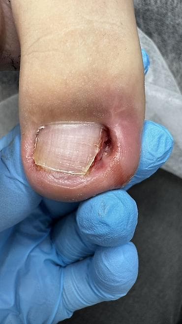 педикюр для мужчин: Коррекция вросших ногтей, Педикюр, Услуги подолога, Консультация — 4