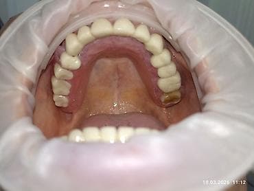 Бандажи, корсеты, корректоры: Съемные частичные зубные протезы - Тип: частичные протезы для верхней — 3