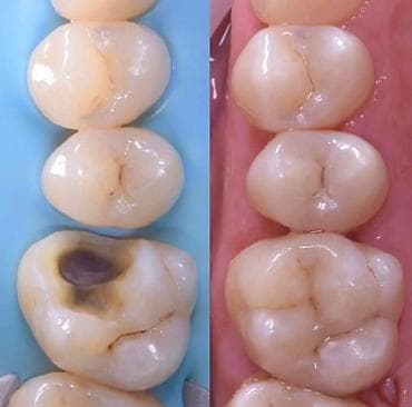 клиника дентомакс бишкек: Лечение кариеса 
Фотопломба
Чистка
Удаление 
Протезирование — 4