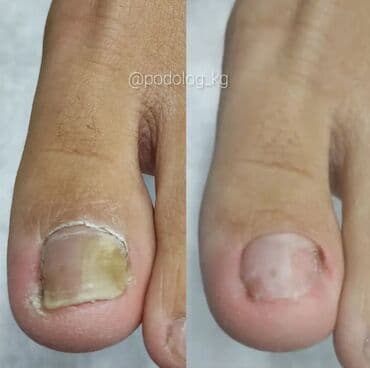 выезд мастера на дом маникюр и педикюр: Коррекция вросших ногтей, Услуги подолога, Педикюр, Маникюр, Консультация, Одноразовые расходные материалы — 1