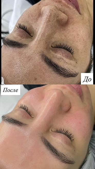 скрабер: Профессиональная чистка лица у вас дома! ✨ Продаю ультразвуковой — 3