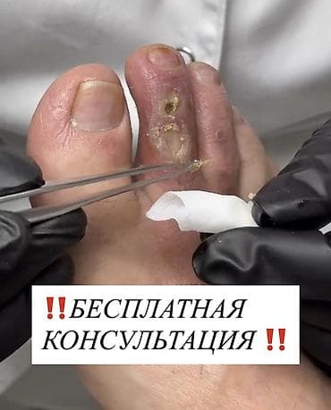 ecco kg: Коррекция вросших ногтей, Услуги подолога, Консультация — 1