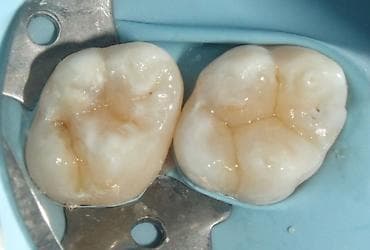 лечение гемороя: 1)Профессиональная 3-х этапная гигиена полости рта (ультразвук — 4