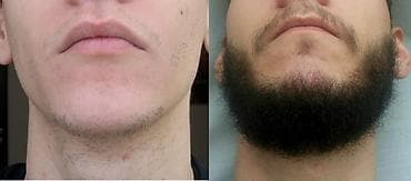 Minoxidil 5%. Миноксидил. Оригинал. США. Первое средство для — 2