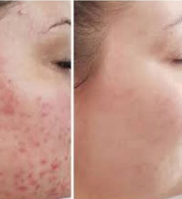 медицинский массаж курсы: Косметология, Демодекоз, Контурное моделирование, Лечение угревой болезни, Консультация, Гипоаллергенные материалы, Сертифицированный косметолог — 2