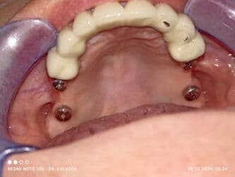 хиджама кровопускание: Клиника | Стоматолог | Протезирование — 7