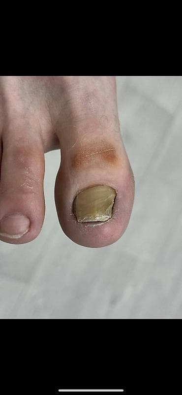 мазоли: Подологический уход за стопами и ногтями Профессиональные процедуры — 1